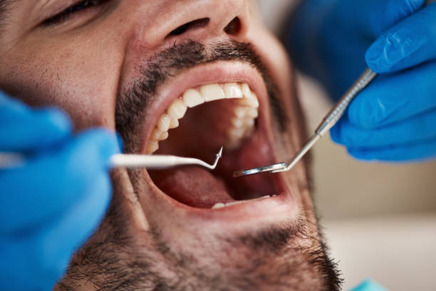 Teeth Whitening in MD